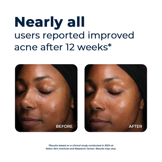 Clear Skin Formula Acne Nutraceutical