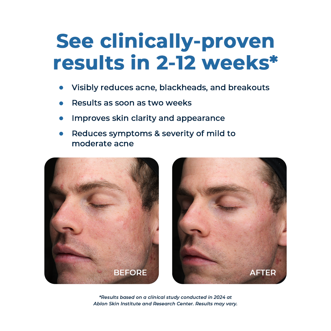 Clear Skin Formula Acne Nutraceutical